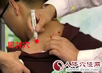 治疗落枕的穴位按摩（专家视频图解）