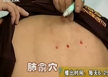 治疗咳嗽的穴位 止咳化痰效果好(视频图解)